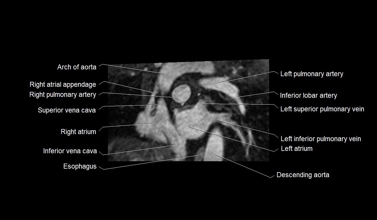 MRI heart and coronary arteries short axis anatomy image 9.webp